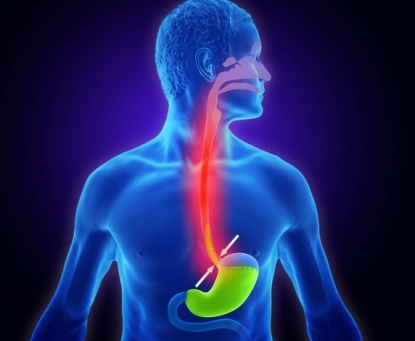 Tư vấn cách phòng ngừa bệnh trào ngược dạ dày thực quản